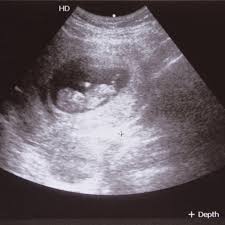 Miscarriage After Detecting A Heartbeat On Ultrasound Particularly with the addition of various diagrams and images to suit all learning styles. miscarriage after detecting a heartbeat
