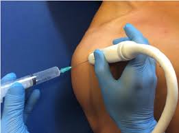 Image result for Biceps Tendon Injection