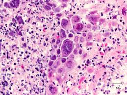Cmv esophagitis usually affects immunosuppressed or immunodeficient people. Intractable Hiccups Due To Herpetic Esophagitis In An Immunocompromised Patient Sciencedirect