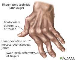 It is a chronic disorder that increases in prevalence with advancing what is the difference between osteoarthritis and rheumatoid arthritis? Rheumatoid Arthritis Ra Symptoms And Causes