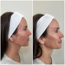 We were honored to host Mary Ellen Bishop @facesbyme Allergan trainer at  Lotti. Focusing