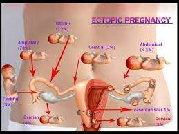Maybe you would like to learn more about one of these? Ectopic Pregnancy Youtube