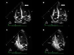 Journal of the american college of cardiology vol. Frontiers The Role Of Multimodality Cardiovascular Imaging In Peripartum Cardiomyopathy Cardiovascular Medicine