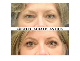 Profile for Been Facial Plastics