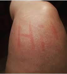 Image result for Dermatographism