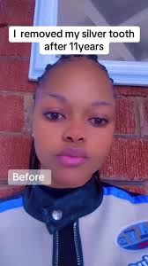 Removing My Silver Tooth After 11 Years: My Journey
