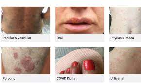 Some people see their skin swell and turn red or dark blue. Covid 19 Skin Rash Website Criticised For Lack Of Bame Examples Coronavirus The Guardian