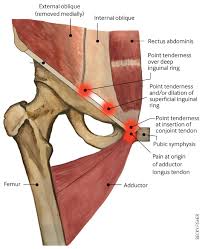 In human anatomy, the muscles of the hip joint are those muscles that cause movement in the hip. Groin Pain In Athletes The Bmj
