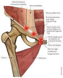 The inguinal ligament is an important connective tissue structure in the inguinal, or groin, region of the human body. Groin Pain In Athletes The Bmj