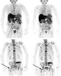 About 80 percent of the time prostate cancer cells metastasize, or spread, they will spread to bones, such as the hip, spine, and pelvis bones. Bone Imaging In Prostate Cancer The Evolving Roles Of Nuclear Medicine And Radiology Springerlink