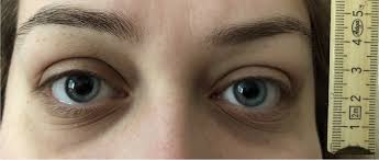Image result for Mydriasis
