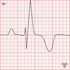 Image result for Right Bundle Branch Block