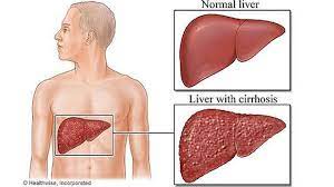 Maybe you would like to learn more about one of these? Sirosis Perjalanan Panjang Sakit Hati Yang Mematikan Health Liputan6 Com