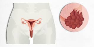 Primary peritoneal cancer and fallopian tube cancer are similar to epithelial ovarian cancer and are treated in the same way. What Is Ovarian Cancer Hospital Clinic Barcelona