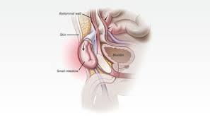 When colon cancers are found at very early stages, the cancerous tissue plus some surrounding nearby tissue is surgically removed if the cancer has invaded the wall of the colon, the cancer is removed along with surrounding colon tissue and the nearby lymph nodes. Inguinal Hernia Treatment Prof Dr Gokhan Cipe