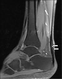 Concordance Of Us And Mri For Diagnosis Of Ligamentous And Tendinous Injuries Around The Ankle Sciencedirect