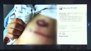 한예슬의 의료사고가 알려지며 관련 국민 청원이 제기되기도 했다. ì „êµ­ í•œì˜ˆìŠ¬ ì˜ë£Œì‚¬ê³  ì°¨ë³'ì› íšŒë³µ ì§€ì› ë³´ìƒ ë…¼ì˜ ì¤' Ytn