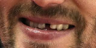 Maybe you would like to learn more about one of these? Alex Ovechkin Goes In For Some Repairs Fixes One Of His Broken Teeth