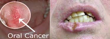 Patches on the lining of the mouth or tongue, usually red or red and white bleeding, pain, or numbness in the mouth mouth ulcers or sores that do not heal Dental Oral Cancer In Meridian Boise Id Grant Dental