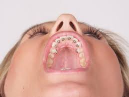 「lingual orthodontics」の画像検索結果