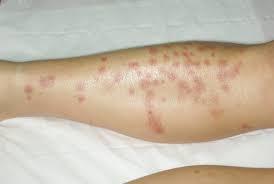 We did not find results for: Dermato Info Les Punaises De Lit