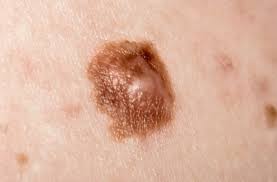 Melanoma When Should You Worry About A Mole Health