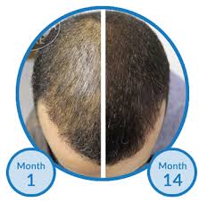 The medicine will not cure hair loss, but it will cause scalp hair to grow. Why Isn T My Hair Loss Treatment Working