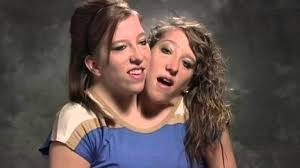 They are dicephalic parapagus twins, and are highly symmetric for conjoined twins, giving the appearance of having a single body without marked variation from typical proportions. Abby Brittany Hensel Finally An Answer About Sex Life The Frisky