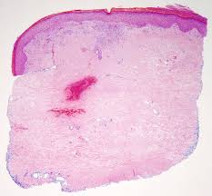 Image result for Scleroderma polyrhizon
