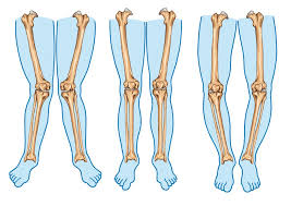 Check spelling or type a new query. Explainer What Causes Knock Knees And Do They Have To Be Treated