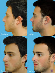 He Was Unhappy With His Dorsal Hump 6 Months Post Op Rhinoplasty Nose Job Male Grooming