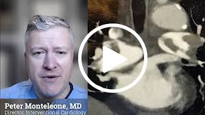 Peter Monteleone discusses cardiology involvement in PE treatment 2024