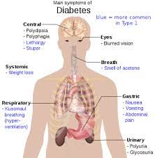 Diabetes gestational adalah penyakit kencing manis yang hanya terjadi pada wanita hamil. Penyakit Kencing Manis Wikipedia Bahasa Melayu Ensiklopedia Bebas