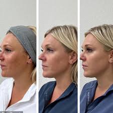 Where my MELASMA girls at? 🙋🏻‍♀️ Its me. I'm raising my hand too. Let me  introduce you to ❕V BIANCO❕ by @promoitalia.usa. The ONLY topical  Tranexamic Acid Professional treatment