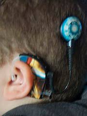 It operates through the hearing instruments and cochlear implants business segments. Sonova Wikipedia
