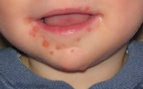 Image result for Mouth ulcers roof of mouth