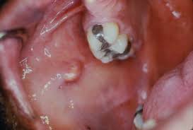 Image result for Sialolithiasis