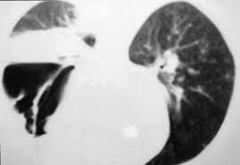 Prokinetics in the management of functional gastrointestinal disorders. Mucormicosis Pulmonar