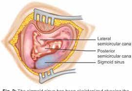 Endolymphatic Sac Surgery For Meniere S Disease Semantic Scholar