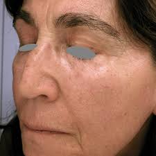 HOW I DO IT Approaches to non-surgical face lifting