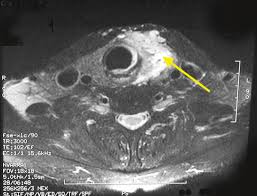 Lei pan, guogang xu, and lei tu accept full responsibility for the conduct of the study. Diagnosis Of Papillary Thyroid Cancer