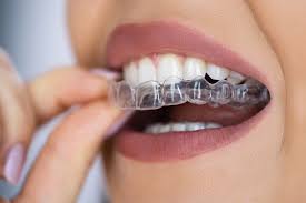 Clear Aligners: A Discreet Solution for Smiles | Open Medscience