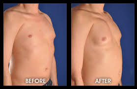 Poland syndrome refers to a congenital unilateral absence of the pectoralis major and minor muscles and is a recognized cause of unilateral hyperlucent hemithorax. Pectoral Implants Pecs Male Chest Reconstruction Male Plastic Surgery