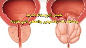 أبي عنده سرطان في البروستات هل هناك من علاج عن طريق الأعشاب لحالته وشكرا. Ø§Ù„Ø§Ø³ØªØ±ÙˆØ¬ÙŠÙ† ÙˆØ§Ù„Ø§Ù†Ø³ÙˆÙ„ÙŠÙ† ÙˆØ¹Ù„Ø§Ù‚ØªÙ…Ù‡Ù…Ø§ Ø¨ØªØ¶Ø®Ù… Ø§Ù„Ø¨Ø±ÙˆØ³ØªØ§ØªØ§ Ø§Ù„Ø­Ù…ÙŠØ¯ Ø·Ø±Ù‚ Ø·Ø¨ÙŠØ¹ÙŠØ© Ù„Ø¹Ù„Ø§Ø¬ Ø£Ø³Ø¨Ø§Ø¨ ØªØ¶Ø®Ù… Ø§Ù„Ø¨Ø±ÙˆØ³ØªØ§ØªØ§ Ø§Ù„Ø­Ù…ÙŠØ¯ Ø·Ø¨ÙŠØ¨ Ù†Øª