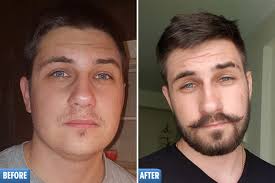 Using minoxidil speeds beard growth and development and allows faster results! Beardless Men Are Rubbing Hair Loss Drug On Their Face For Fuller Fuzz But Experts Warn It Could Fall Out