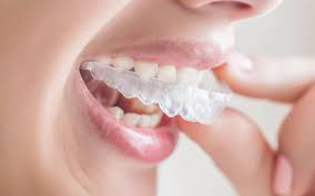 Stay in place for an extended amount of time, and exert steady pressure. Invisalign Braces Essex Braces Vs Invisalign For Overbite Treatment