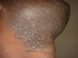 If you're a black man with straight hair and you're looking for simple, yet great styles to try on, we've got news for you! Www Ingrown Hair Co Uk Picture Of Effects Ingrown Hair On A Black Man Ingrownhairbikini Ingrown Hair Treat Ingrown Hair Ingrown Hair Bikini