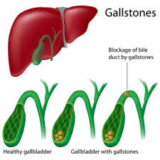 Sharp pain in the upper right quadrant of the abdomen (that may radiate travel to the right shoulder. Gallbladder Stones Symptoms Causes Pain Surgery And Treatment