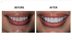 Non-Prep Veneers: The Revolutionary Solution | Top Doctors