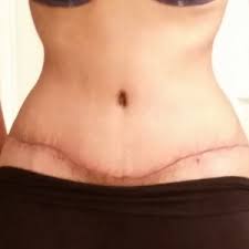 Concerning the tummytuck tats graphics this short article focuses on how to pick your correct tummytuck tattoos pictures to full cover up your tummy tuck scars find assistance from the experts to prevent the problems with the tummytuck tattoo image selection, you'll be in a position to locate. Would You Recommend A Tattoo To Cover My Tummy Tuck Scar Photos